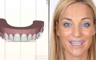 Dental mock-up: a clinical guide to planning, validating and achieving predictable aesthetic results
