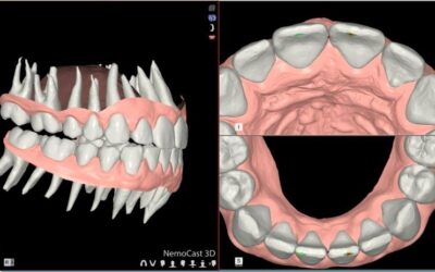 Articulador virtual de Nemotec (NemoStudio): análisis oclusal 3D y soporte a la planificación digital