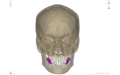 Microtornillos en ortodoncia y planificación digital: cómo reducir errores de posición