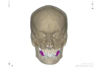 Microtornillos ortodoncia (1)