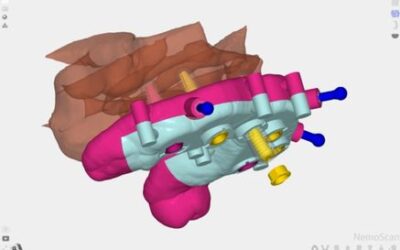 Planificación de implantes dentales: factores clínicos que determinan la precisión y predictibilidad del caso