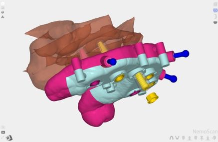 Planificación de implantes dentales