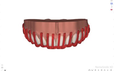 Encerado digital dental: papel en la planificación restauradora y en la validación estético-funcional del caso